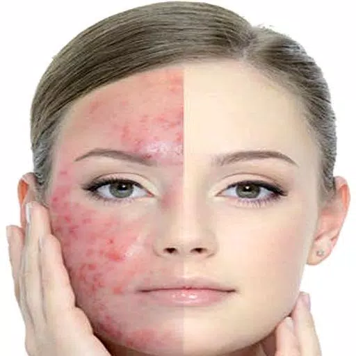 Get Rid of Acne  (Guide) Schermafbeelding 1